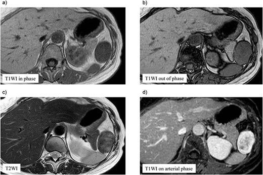 Preoperative magnetic resonance (MR) imaging findings. The tumor shows low signal intense mass on T1-weighted MR images in phase (a) and out of phase (b) and a heterogeneous hyperintense mass on T2-weighted MR images (c). (d) The tumor shows hypointense tumor on T1-weighted MR images with delayed enhancement in the arterial phase.