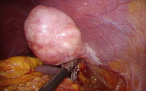 Intraoperative findings. Laparoscopic view showing the solitary fibrous tumor bulging into the abdominal cavity with a stalk, with its peritoneal surface covered with hard nodules.