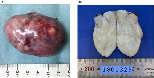 Macroscopic findings of the resected specimen. (a) The resected specimen measuring 5.9 × 3.5 cm has a multinodular whitish appearance. (b) The cut surface of the resected tumor is solid and yellowish-white.