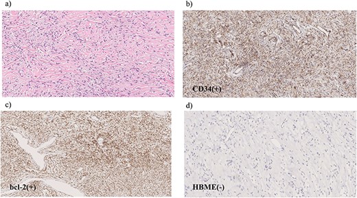 Microscopic findings of the specimen. (a) Hematoxylin and eosin staining reveals spindle-shaped tumor cells with elongated nuclei. Immunohistochemical examination shows tumor cells positive for CD34 (b) and Bcl-2 (c) but negative for HBME-1 (d).