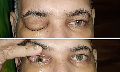 Periorbital oedema of the right eyelids; note the absence of chemosis and proptosis.