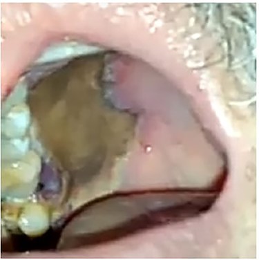 Oral cavity view showing extensive necrosis of the right palate.