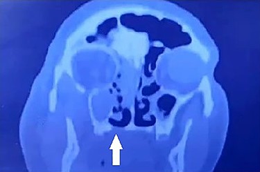 Coronal CT showing bony erosion of the right side of the hard palate (white arrow) with ipsilateral maxillary and ethmoid opacification.