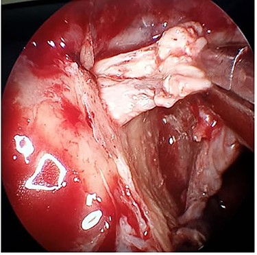 Intraoperative endoscopic image of the thrombosed right sphenopalatine artery.