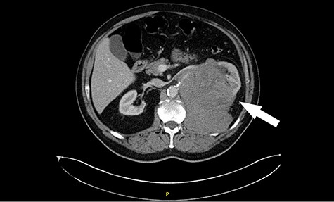 Computed tomography (CT) revealing a large insinuating left renal soft tissue mass measuring 140 × 105 mm.