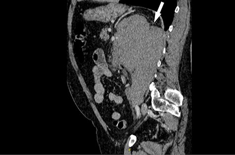 Computed tomography (CT) sagittal section showing predominant bulk of the mass is extrarenal that posteriorly breaches the fascia to involve the diaphragm and psoas muscle. Medially it reaches the intervertebral foramen.