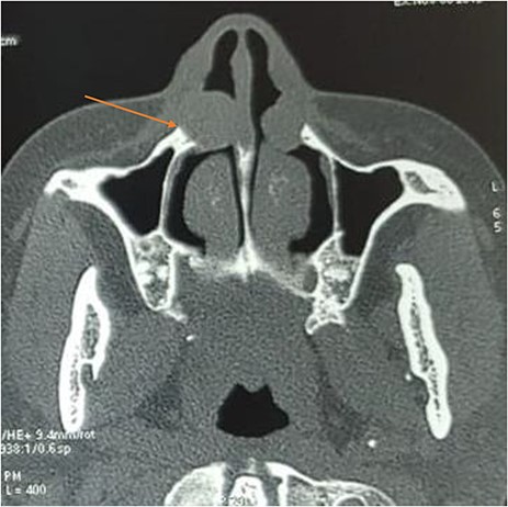 Axial computed tomography showing a bilateral well-defined, hypodense, extraosseous lesion near the ala nasi; note the cortical scalloping on the right side (arrow).