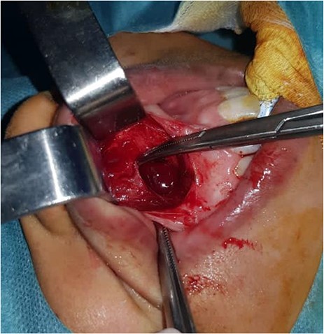 Intraoperative appearance of the cyst.