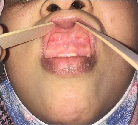 Appearance 8 months after surgical treatment.