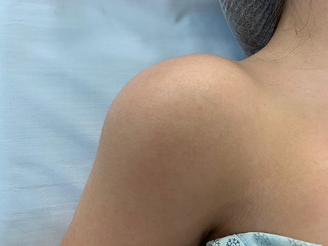 Clinical image of the patient’s right shoulder. We observed an increased volume of the shoulder as a whole, with no changes in the associated skin.