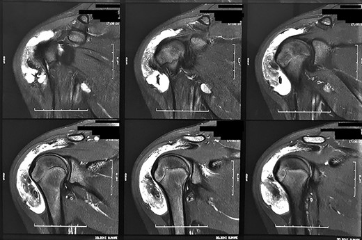 Magnetic resonance images of the patient. We observed coronal sections of the right shoulder in a sensitive liquid sequence, showing intense diffuse subacromial synovial thickening, associated with grouped images in the topography of the bursa.