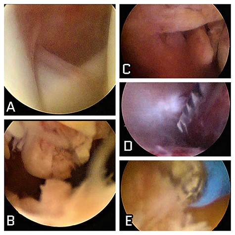Intraoperative images of the patient. (A) Intra-articular image of the shoulder showing absence of local involvement; (B) subacromial view showing intense characteristical synovitis; (C) nodulations with synovial aspect in the subdeltoid lateral space; (D) shaver synovectomy; (E) radiofrequency thermal ablation synovectomy as effective arthroscopic resources in surgical treatment.