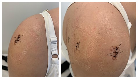 Clinical images of the patient 10 days after surgery. In the left image, we observe an important decrease in the shoulder volume when compared with the preoperative image (Fig. 1). In the right image, we can see the positioning of the arthroscopic portals performed during surgery.