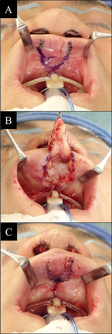 Reconstruction surgery steps of vermillion tubercle deformity. (A) Incision line design of lip mucosa; (B) flap was dissected until the muscle layer exposed; (C) flap then being advanced to more protrusive position and sutured.