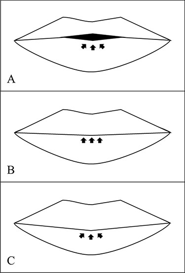 Three structure of lip vermilion tubercle. (A) Typical whistling deformity lip is deficit of vermilion tubercle, and incomplete lip seal is marked by arrows; (B) flat vermilion tubercle has complete lip seal, but the volume of tubercle is not full as normal; (C) ideal lip is marked by complete lip seal, enough volume of vermilion tubercle and balance of upper and lower lip.