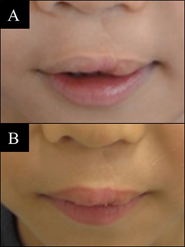 Case 1 with unilateral left side cleft lip. (A) Before vermilion reconstruction surgery and (B) 10 months after the V-Y advancement flap surgery.