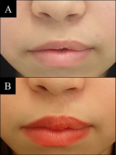 Case 2 with unilateral left side cleft lip. (A) Before vermilion reconstruction surgery and (B) 2 years after the V-Y advancement flap surgery.
