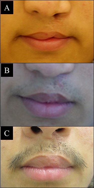 Case 3 with unilateral left side cleft lip. (A) Before vermilion reconstruction surgery; (B) 6 months after the first V-Y advancement flap surgery; (C) 2 years after the second V-Y advancement flap surgery.
