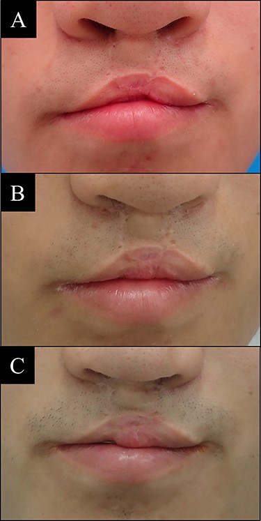 Case 4 with bilateral side cleft lip. (A) Before vermilion reconstruction surgery; (B) 1 year after the first V-Y advancement flap surgery; (C) 1 year after the second V-Y advancement flap surgery.