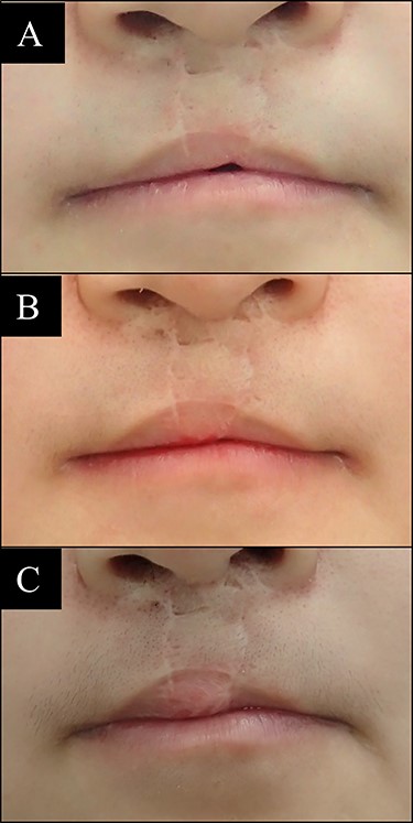 Case 5 with bilateral side cleft lip. (A) Before vermilion reconstruction surgery; (B) 8 months after the first V-Y advancement flap surgery; (C) 7 months after the second V-Y advancement flap surgery.