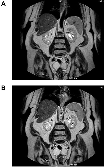 (A and B) Coronal images of MR showing bilateral ovarian teratoma.