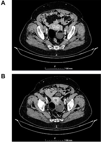 (A and B) Axial images of CT scan showing in the right ovary, a solid mass with predominantly fat density of 55 mm; and in the left ovary, a predominantly cystic mass of 65 mm.