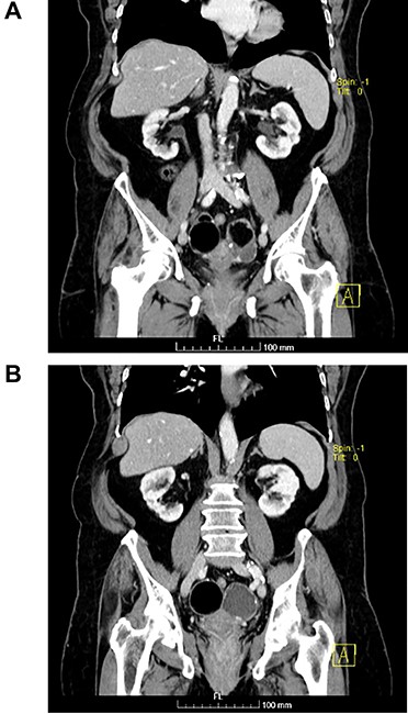 (A and B) Coronal images of CT showing bilateral ovarian lesions.