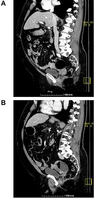 (A and B) Sagittal images of CT showing bilateral ovarian lesions.