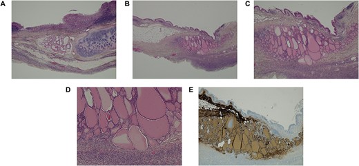 Histological images of the ovaries. (A) Ovary with characteristic features of a mature cystic teratoma (haematoxylin–eosin (HE) staining, 20x). (B-D) Presence of thyroid parenchyma (HE staining, 10x, 40x and 100x, respectively). (E) Positivity for thyroglobulin in immunohistochemistry (40x).