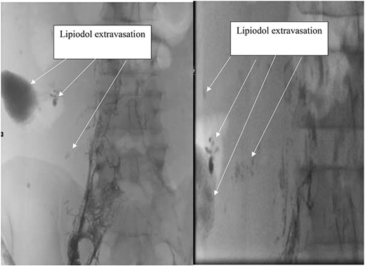 Lymphangiogram with lipiodol showing Lipiodol extravasation at the site of chyle leak.