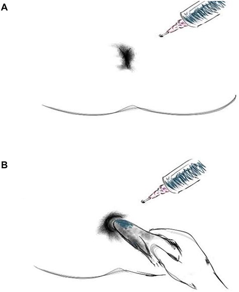 (A) Methylene blue is instilled via the external opening and (B) stain on the gauze piece checked.
