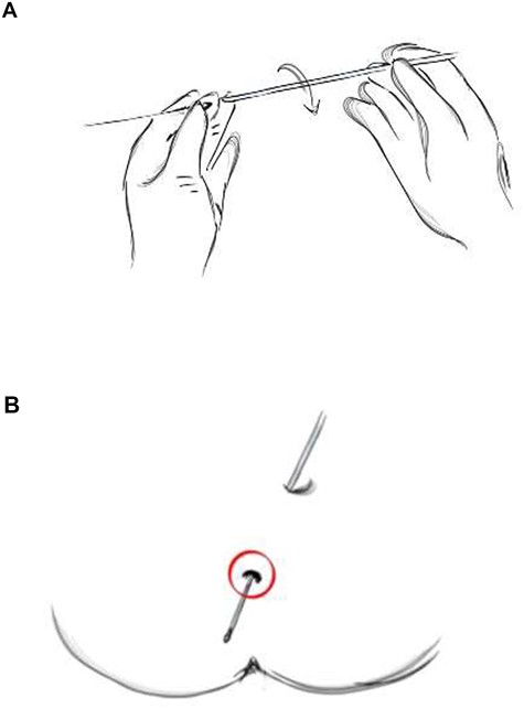 (A) The olive-tip probe is mounted on the guidewire, and (B) the tract probed till the olive-tip is seen at the internal opening.