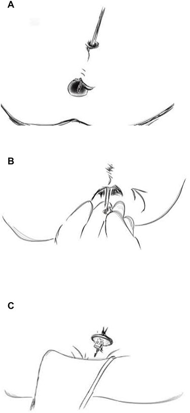 (A) Next, the olive-tip is dismantled and (B) replaced with the endplate by screwing it on to the guide-rod and the (C) rod gently pulled to snugly fit the endplate at the internal opening.