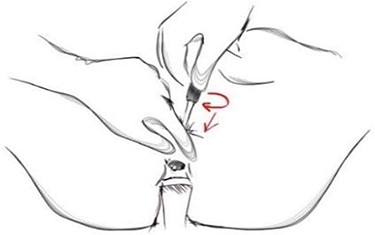 The circular cutter is next introduced over the rod and with rotatory movements propelled toward the endplate.