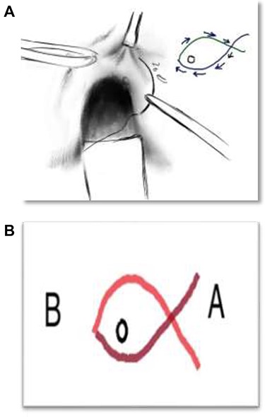 (A) ‘Fish-eye closure technique’. (B) To describe the details, (i) Vicryl 2/0 from point A to B, (ii) return from point B to A, (iii) 5 mm away from Internal opening, (iv) depth is up to internal sphincter muscle.