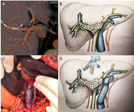 Since significant left portal vein narrowing at its origin due to tumor infiltration (A, B) contraindicated upfront right portal vein embolization, which was deemed potentially ineffective and at risk of favoring portal trunk thrombosis, porto-portal shunt by the mean of an autologous internal jugular vein graft interposition, followed by right and middle hepatic veins embolization, was performed (C, D).