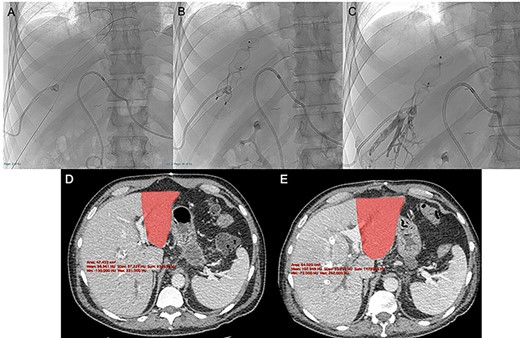 After US-guided percutaneous transhepatic access with micropuncture sets (A) the right and middle HVE was performed using two 90% oversized vascular plugs (B) and then completed with 2:1 Lipiodol-glue mixture (C), resulting in a 26.8% increase in volume of the FLR (501 vs. 395 cc) after 9 days with a kinetic growth rate (KGR) of 11.8 cc/days (D, E).