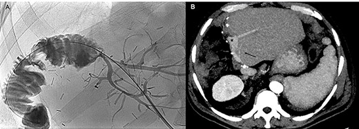 The cholangiogram performed 1 month after the hepatic resection (A) and the CT scan performed 5 months later (B) show regular patency of the bilio-enteric anastomosis, absence of biliary leaks and patency of the portal graft, the left portal branches (black asterisk) and left hepatic artery (black arrow), without signs of local recurrence.