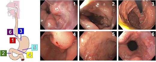 Results of EGD showing dispersed, 3-mm non-bleeding erosions in the gastric antrum.