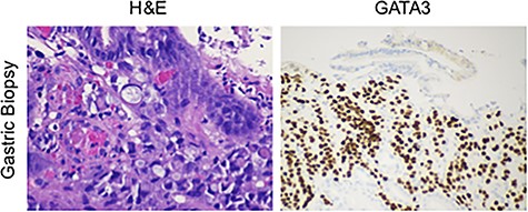 Tissues from the gastric biopsy were stained with either H&E or for GATA3, showing a poorly differentiated signet ring carcinoma of breast origin.