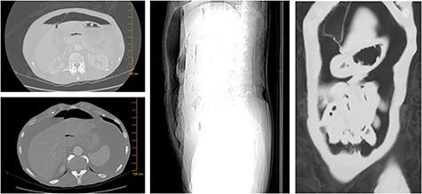 Imaging studies revealing free air in the abdomen.