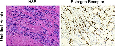 Contents of the umbilical hernia were stained with either H&E or for the ER, showing a poorly differentiated, ER positive, signet ring carcinoma with lobular features.