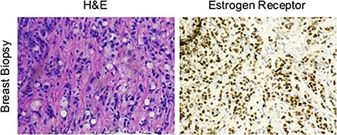 Tissues from breast biopsy were stained with either H&E or for the ER, showing an invasive lobular carcinoma with signet ring cell features.
