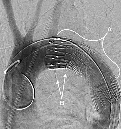 A fluoroscopy image in the sagittal plane showing: (A) the stent-graft within the aorta and (B) the denture.
