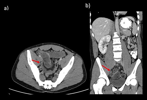CT abdomen findings from Cases 1 and 2 showing distal SBO with the transition point in the pelvis. (a) Case 1 CT axial view. (b) Case 1 CT coronal view.