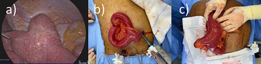 Operative findings from Cases 1 and 2 of MD at the transition point. (a) Case 1 laparoscopic image showing MD. (b) Case 1 operative image of MD (after conversion to mini-laparotomy). (c) Case 2 operative image of MD (after conversion to mini-laparotomy).
