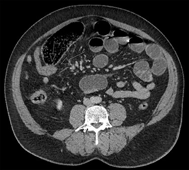 Case 2 CT abdomen axial view showing a distal SBO.