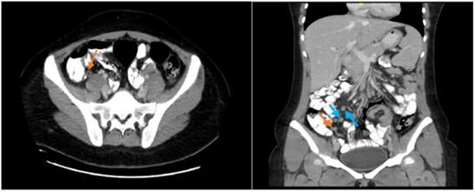Abdominal CT scan showing an enhanced appendix, not filing with contrast and no surrounding fat stranding or collections (axial view) with associated multiple enlarged inguinal and retroperitoneal lymph nodes (coronal view).