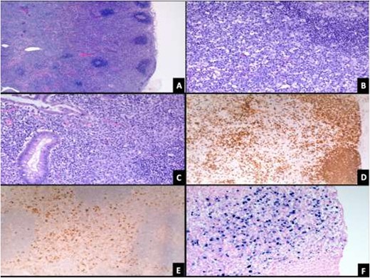 (A) Lymph node showing paracortical expansion and scattered reactive follicles (H&E stain, 50X). (B) There are numerous large lymphoid cells (mostly B-cells) with immunoblastic morphology and increased plasma cells (H&E stain, 200X). (C) Appendix shows increased immunoblasts within the mucosa (H&E stain, 200X). Immunoblasts are positive for CD20 (D), CD30 (E) and EBV-EBER (F) stains.