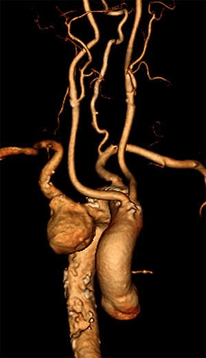 Computed tomography (CT) reconstruction illustrating Kommerell’s diverticulum and an aberrant right subclavian artery.